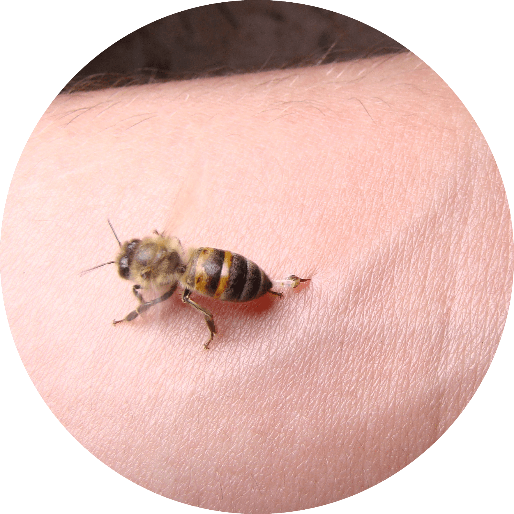 Allergia veleno di Imenotteri