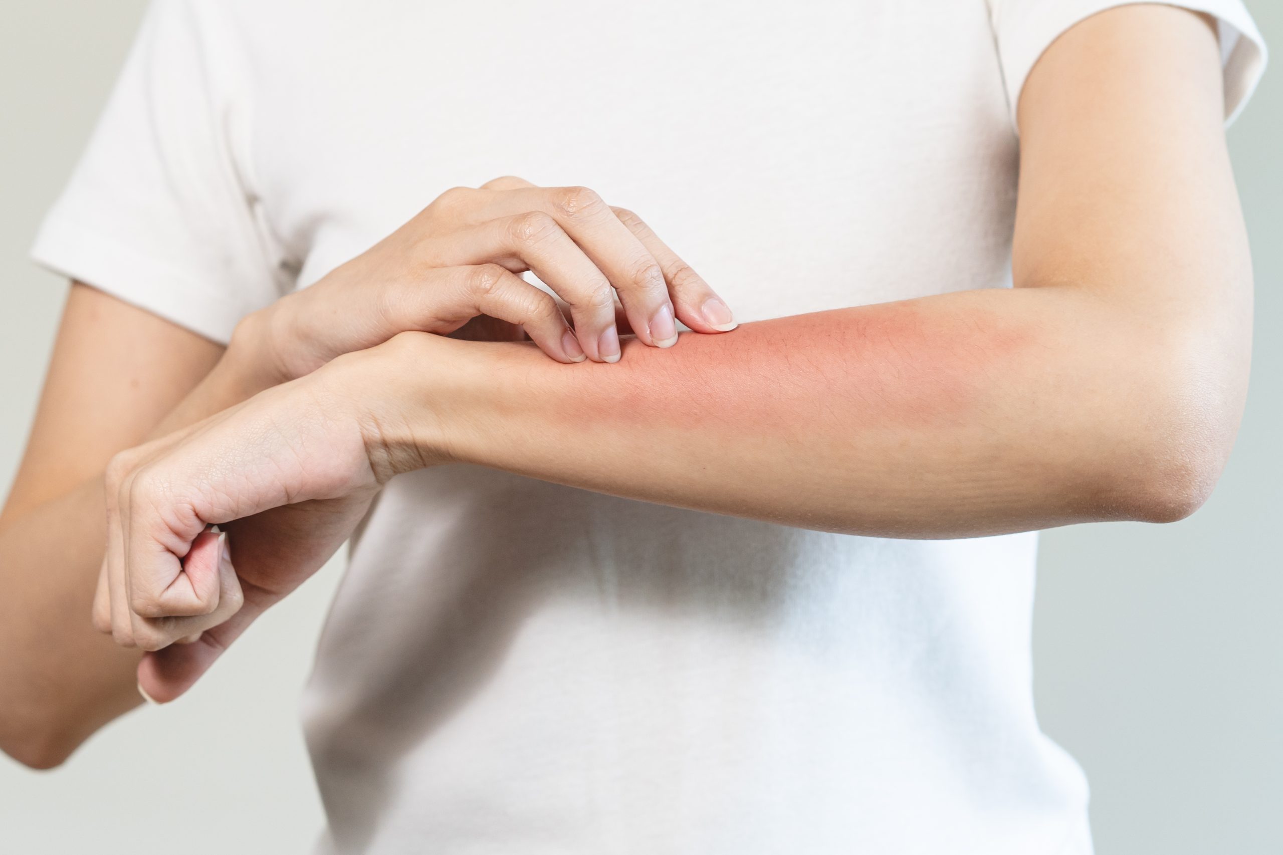 person have red rash on arm from insect bite allergic.