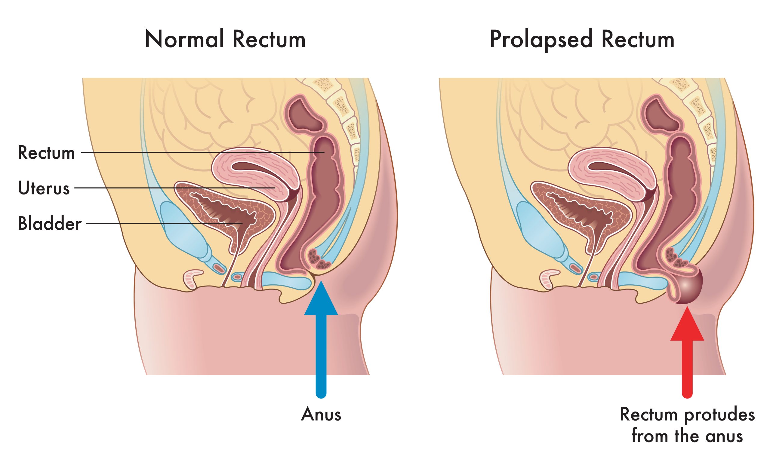 Medical illustration showing the difference between a normal rectum and a prolapsed rectum, with annotations explaining how this occurs.