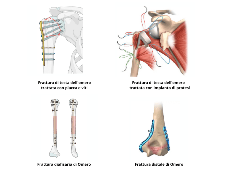frattura spalla clavicola e braccia