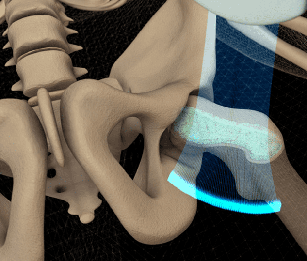 "A close-up medical image of the pelvic area, display a uterus, bladder, and surrounding tissues, with a prominent pelvic bone outline."